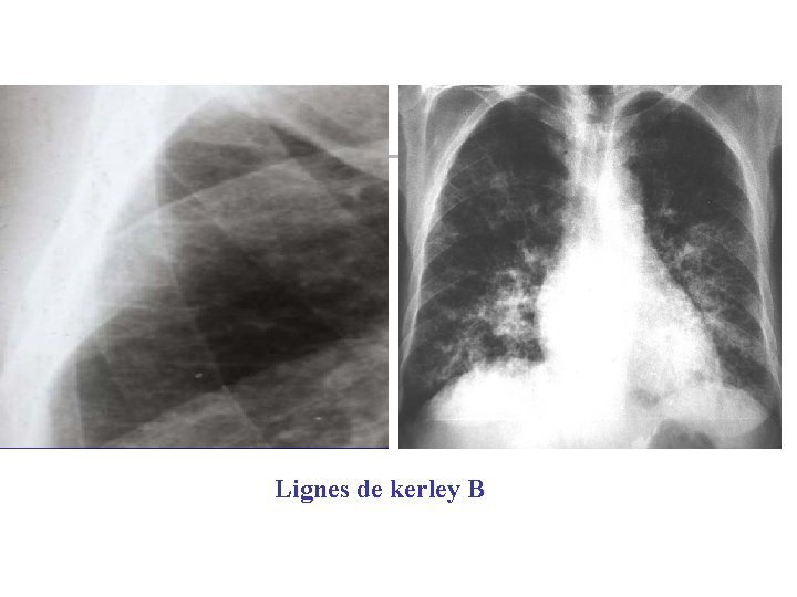 Lignes de kerley B 