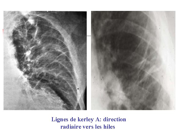 Lignes de kerley A: direction radiaire vers les hiles 