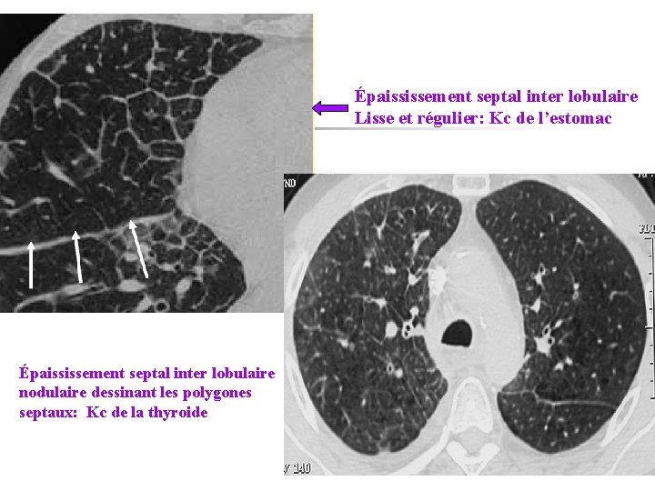 Épaississement septal inter lobulaire Lisse et régulier: Kc de l’estomac Épaississement septal inter lobulaire