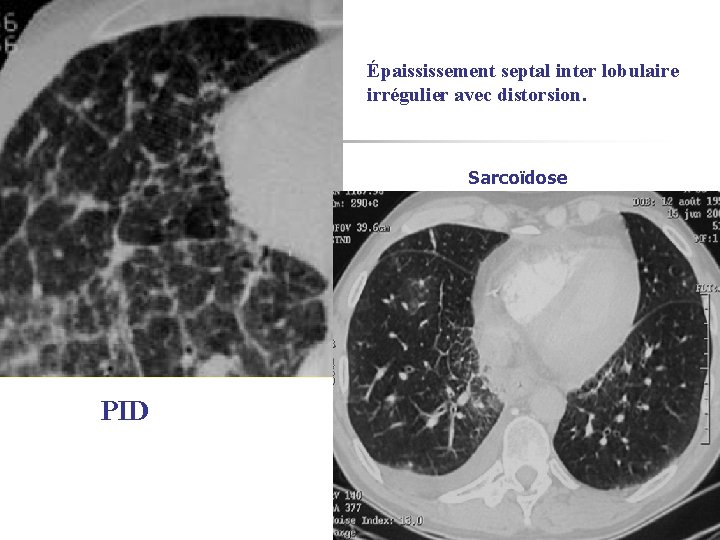 Épaississement septal inter lobulaire irrégulier avec distorsion. Sarcoïdose PID 