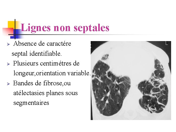 Lignes non septales Absence de caractére septal identifiable. Ø Plusieurs centimétres de longeur, orientation