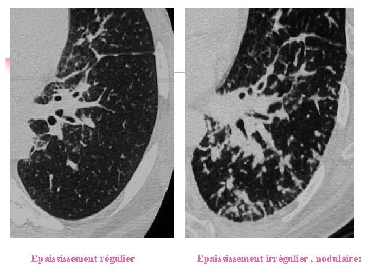 Epaississement régulier Epaississement irrégulier , nodulaire: 