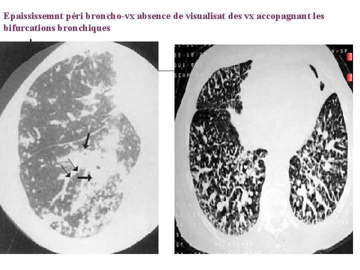 Epaississemnt péri broncho-vx absence de visualisat des vx accopagnant les bifurcations bronchiques 