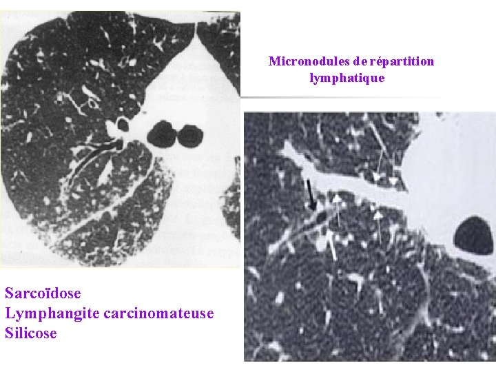 Micronodules de répartition lymphatique Sarcoïdose Lymphangite carcinomateuse Silicose 