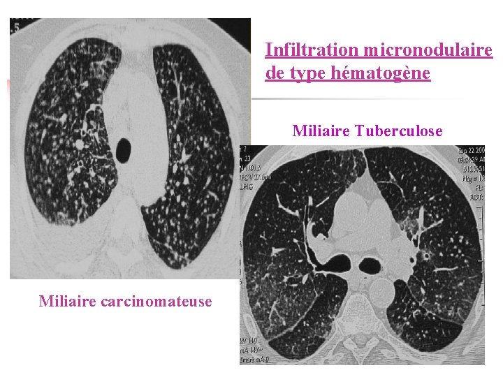 Infiltration micronodulaire de type hématogène Miliaire Tuberculose Miliaire carcinomateuse 