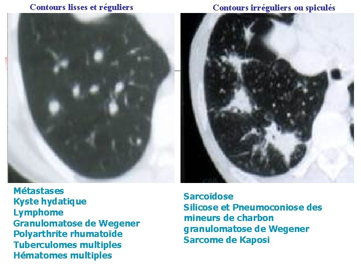 Contours lisses et réguliers Métastases Kyste hydatique Lymphome Granulomatose de Wegener Polyarthrite rhumatoïde Tuberculomes