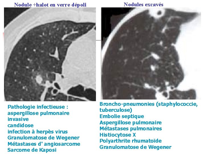 Nodule +halot en verre dépoli Pathologie infectieuse : aspergillose pulmonaire invasive candidose infection à