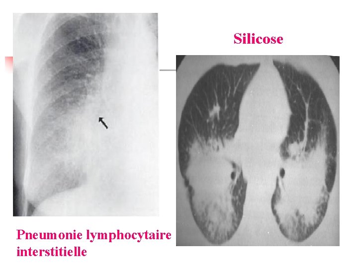 Silicose Pneumonie lymphocytaire interstitielle 