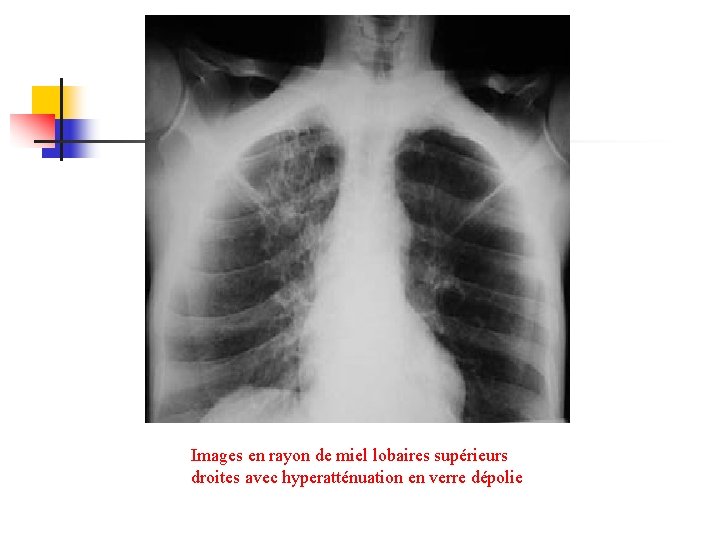 Images en rayon de miel lobaires supérieurs droites avec hyperatténuation en verre dépolie 