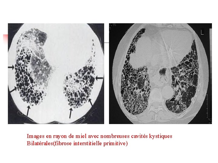 Images en rayon de miel avec nombreuses cavités kystiques Bilatérales(fibrose interstitielle primitive) 