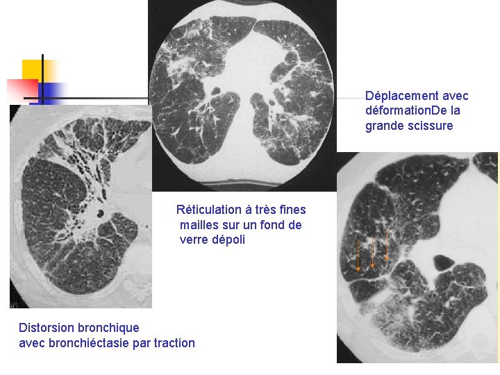 Déplacement avec déformation. De la grande scissure Réticulation à très fines mailles sur un