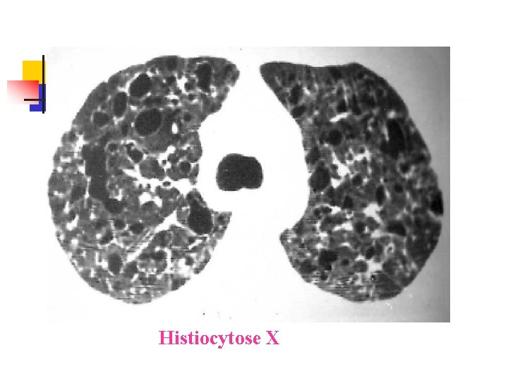 Histiocytose X 