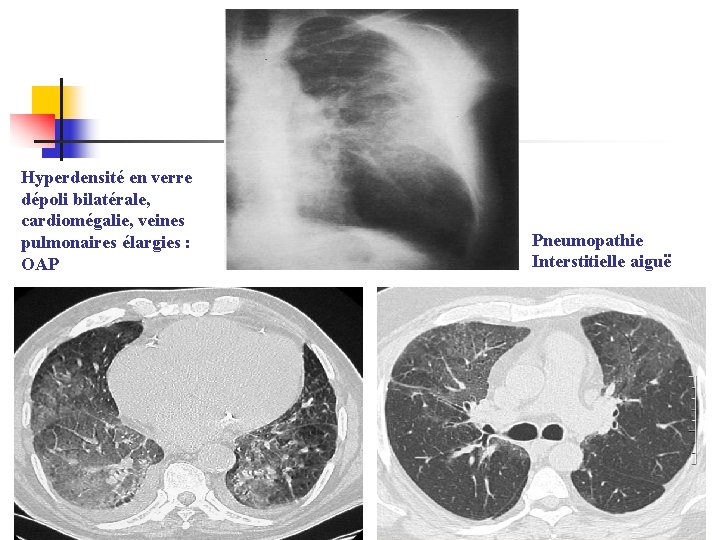 Hyperdensité en verre dépoli bilatérale, cardiomégalie, veines pulmonaires élargies : OAP Pneumopathie Interstitielle aiguë