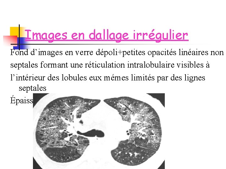 Images en dallage irrégulier Fond d’images en verre dépoli+petites opacités linéaires non septales formant