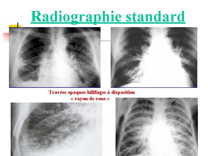 Radiographie standard Travées opaques hilifuges à disposition « rayon de roue » 