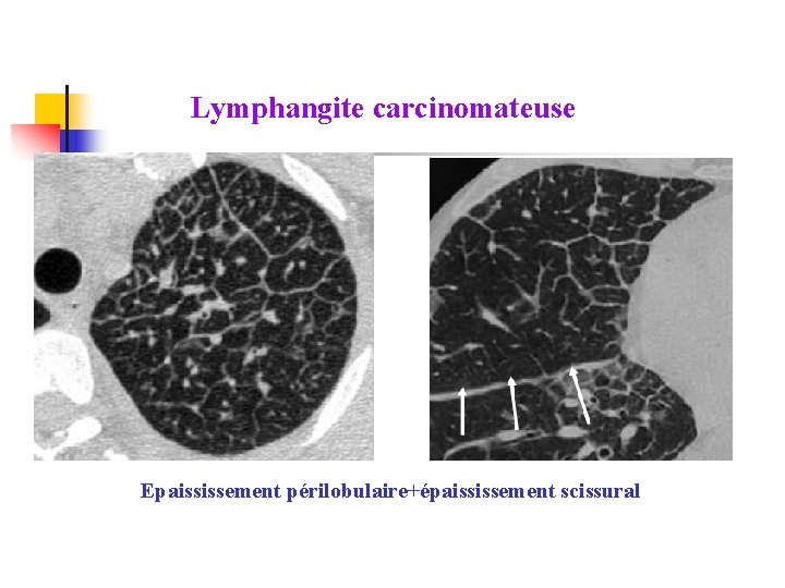 Lymphangite carcinomateuse Epaississement périlobulaire+épaississement scissural 
