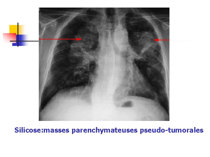 Silicose: masses parenchymateuses pseudo-tumorales 