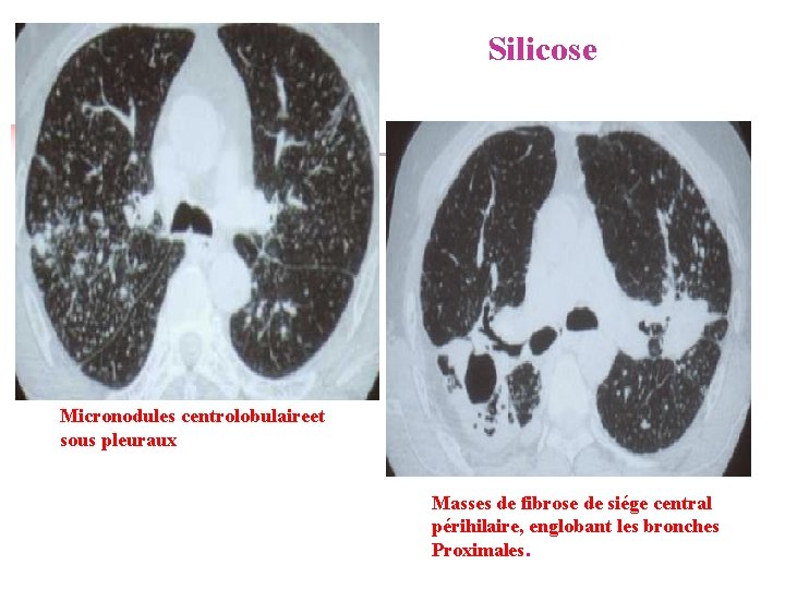 Silicose Micronodules centrolobulaireet sous pleuraux Masses de fibrose de siége central périhilaire, englobant les