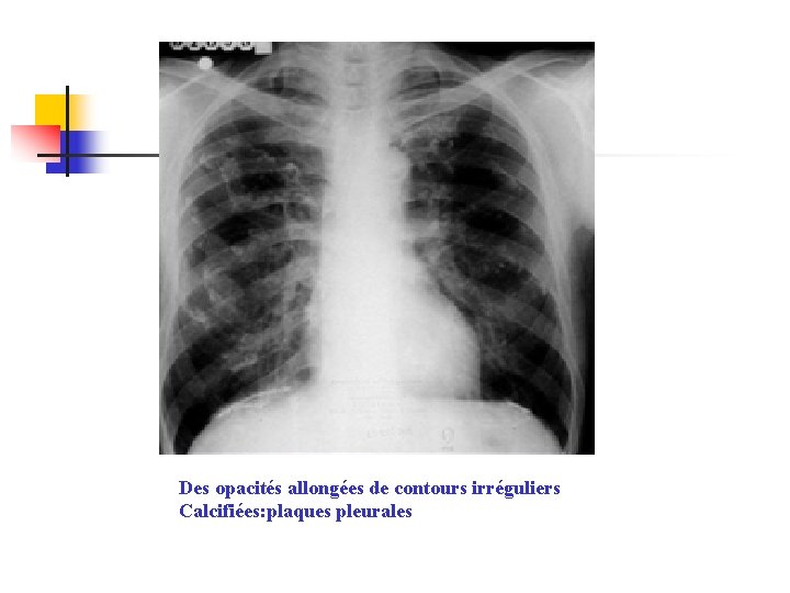 Des opacités allongées de contours irréguliers Calcifiées: plaques pleurales 