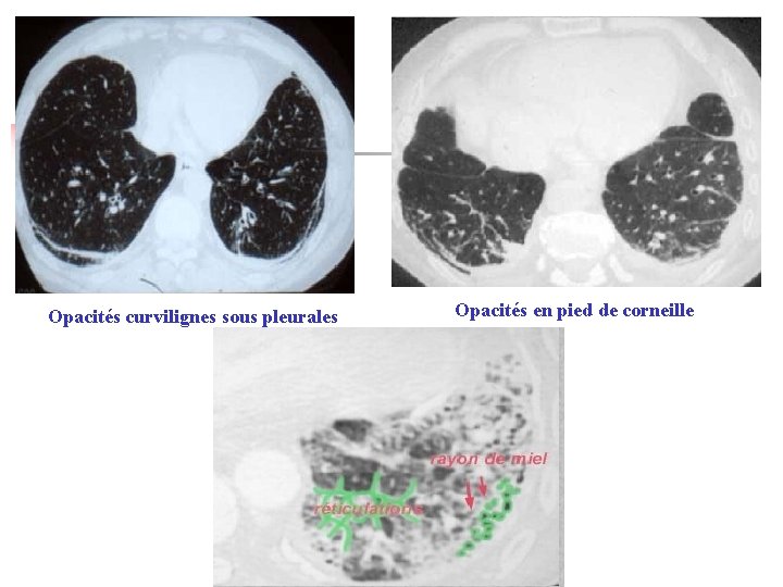 Opacités curvilignes sous pleurales Opacités en pied de corneille 