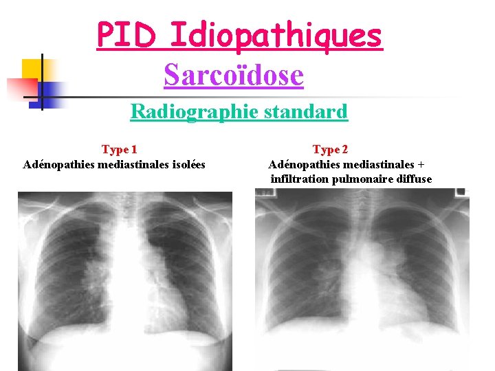 PID Idiopathiques Sarcoïdose Radiographie standard Type 1 Adénopathies mediastinales isolées Type 2 Adénopathies mediastinales