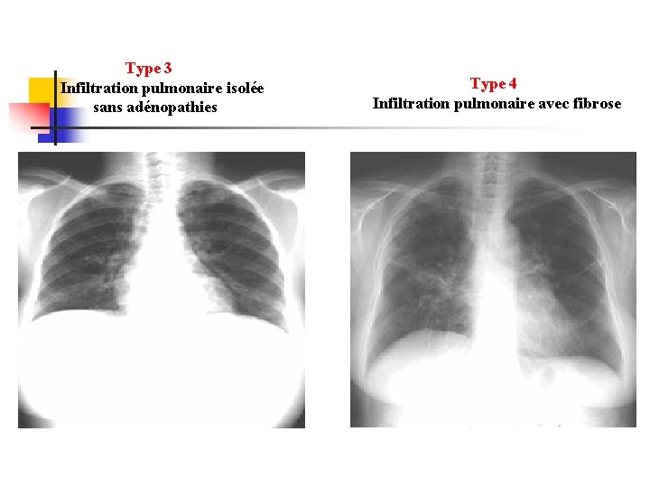  Type 3 Infiltration pulmonaire isolée sans adénopathies Type 4 Infiltration pulmonaire avec fibrose