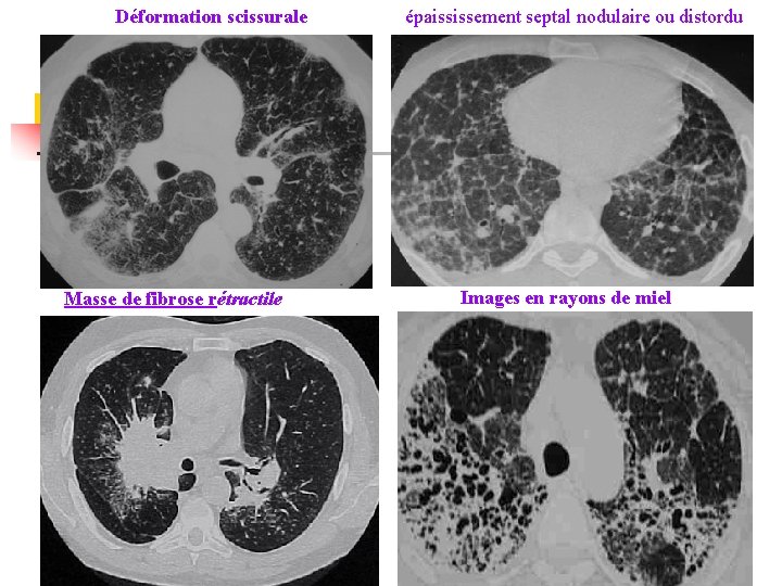 Déformation scissurale Masse de fibrose rétractile épaississement septal nodulaire ou distordu Images en rayons