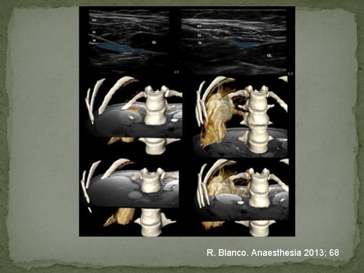 R. Blanco. Anaesthesia 2013; 68 