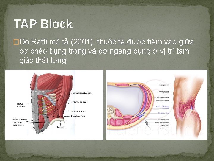 TAP Block �Do Raffi mô tả (2001): thuốc tê được tiêm vào giữa cơ