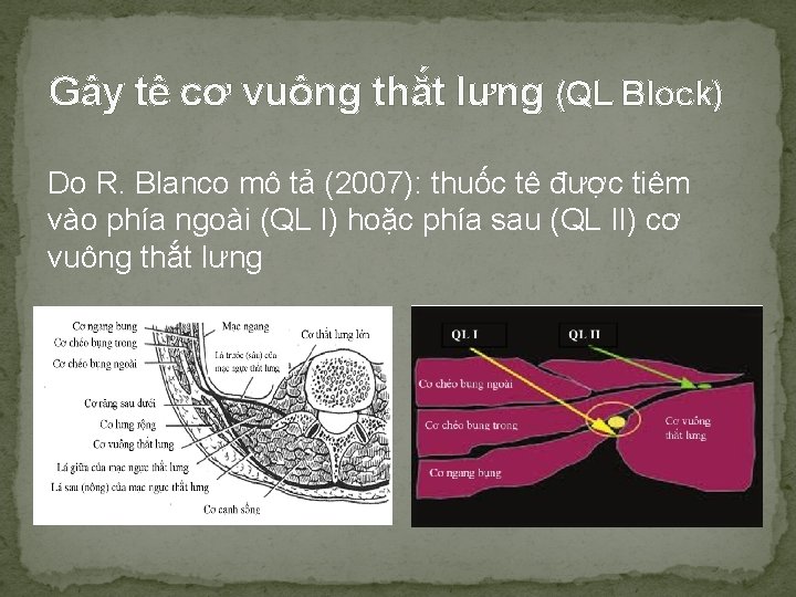 Gây tê cơ vuông thắt lưng (QL Block) Do R. Blanco mô tả (2007):