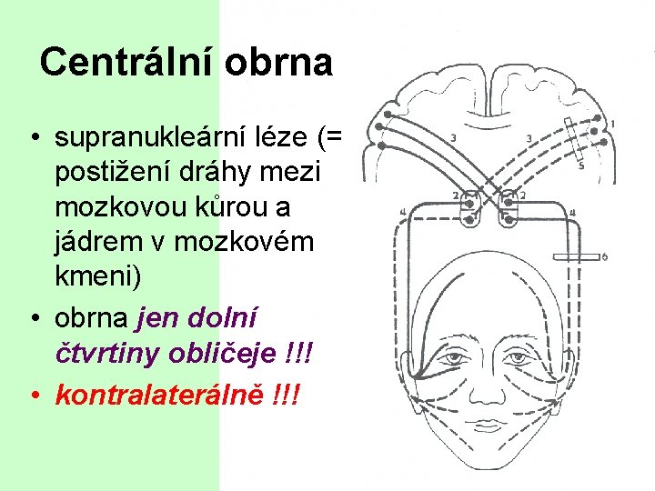 Centrální obrna • supranukleární léze (= postižení dráhy mezi mozkovou kůrou a jádrem v