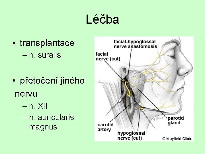 Léčba • transplantace – n. suralis • přetočení jiného nervu – n. XII –