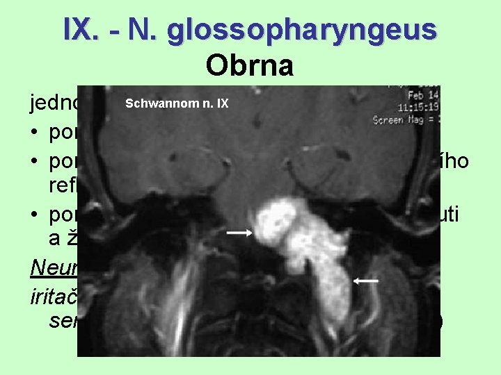 IX. - N. glossopharyngeus Obrna Schwannom n. IX jednostranná • poruchy polykání (= mírná