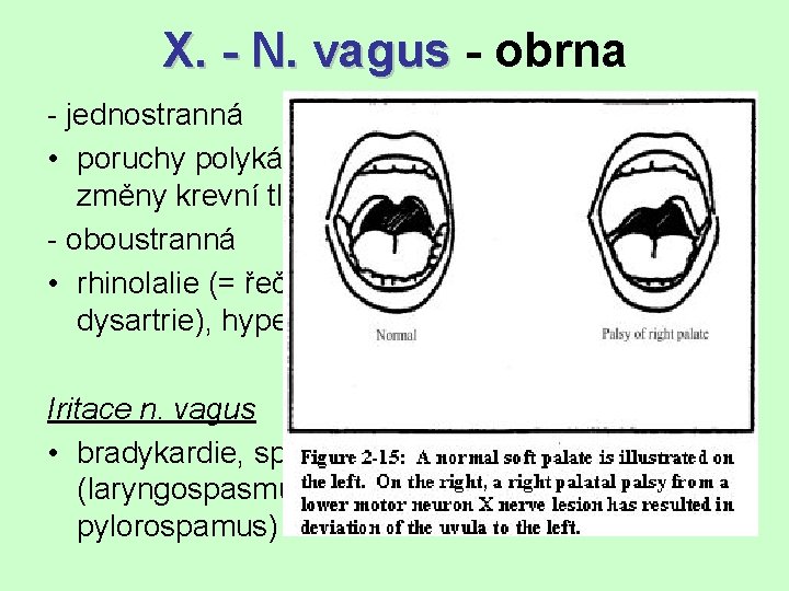 X. - N. vagus - obrna - jednostranná • poruchy polykání (= dysfagie), chraptění,