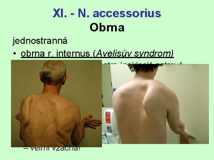 XI. - N. accessorius Obrna jednostranná • obrna r. internus (Avelisův syndrom) – porucha