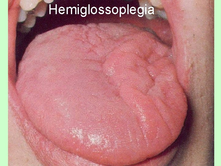 Hemiglossoplegia 