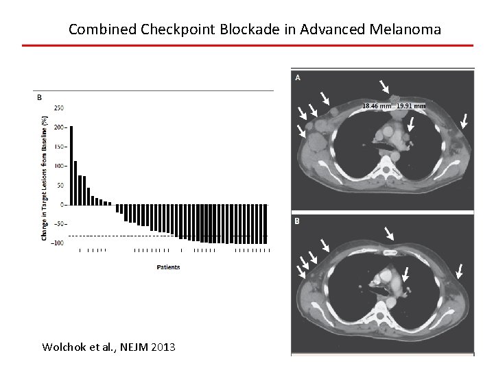 Combined Checkpoint Blockade in Advanced Melanoma Wolchok et al. , NEJM 2013 