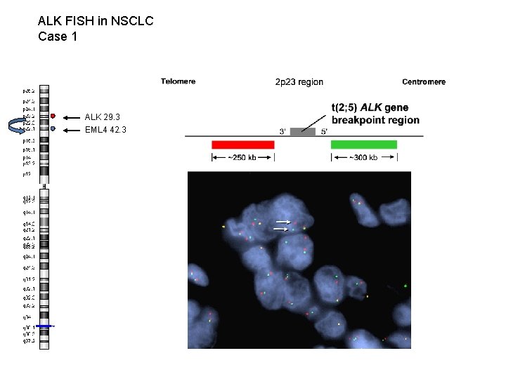 ALK FISH in NSCLC Case 1 ALK 29. 3 EML 4 42. 3 WT