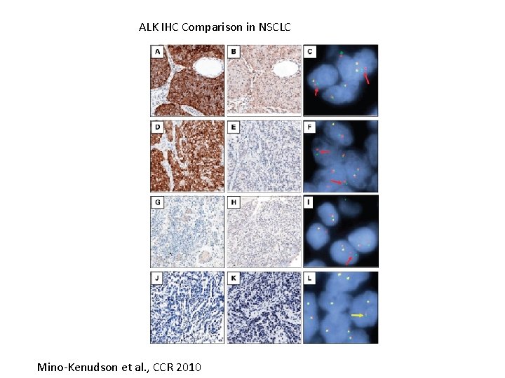 ALK IHC Comparison in NSCLC Mino-Kenudson et al. , CCR 2010 