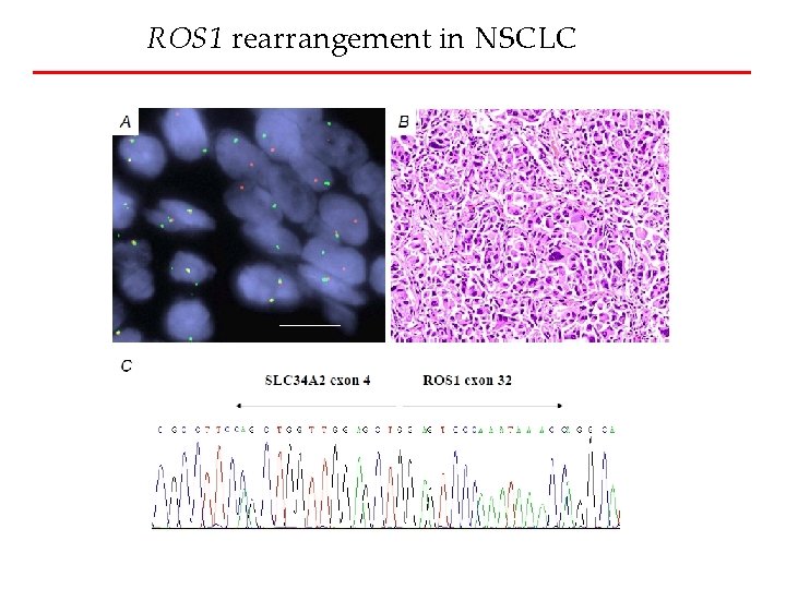 ROS 1 rearrangement in NSCLC 