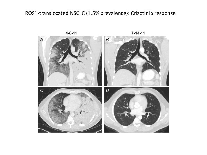 ROS 1 -translocated NSCLC (1. 5% prevalence): Crizotinib response 