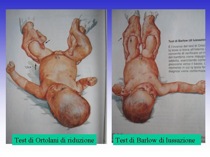 Test di Ortolani di riduzione Test di Barlow di lussazione 