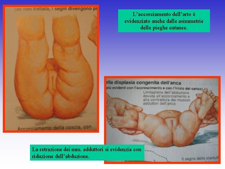 L’accorciamento dell’arto è evidenziato anche dalle asimmetrie delle pieghe cutanee. La retrazione dei mm.