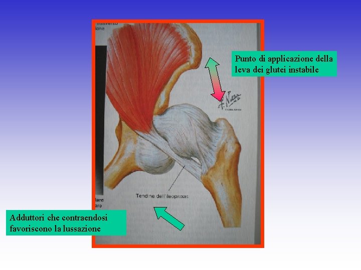 Punto di applicazione della leva dei glutei instabile Adduttori che contraendosi favoriscono la lussazione