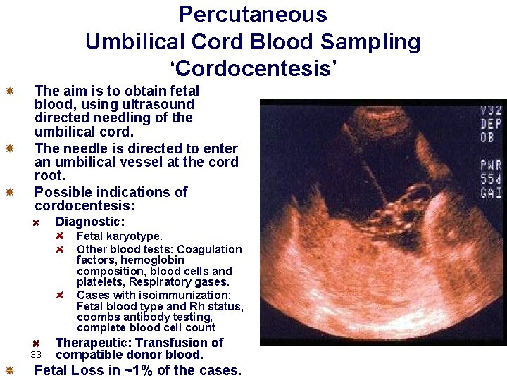 Percutaneous Umbilical Cord Blood Sampling ‘Cordocentesis’ The aim is to obtain fetal blood, using