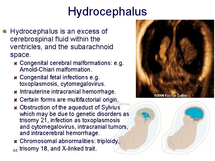 Hydrocephalus is an excess of cerebrospinal fluid within the ventricles, and the subarachnoid space.