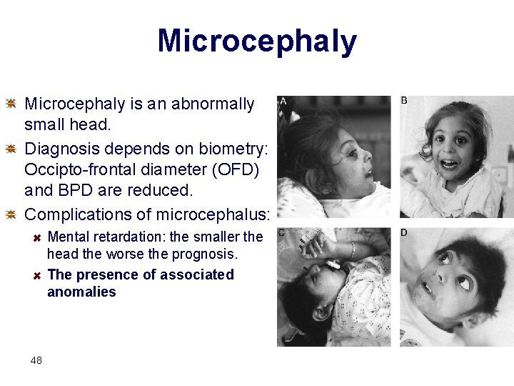 Microcephaly is an abnormally small head. Diagnosis depends on biometry: Occipto-frontal diameter (OFD) and