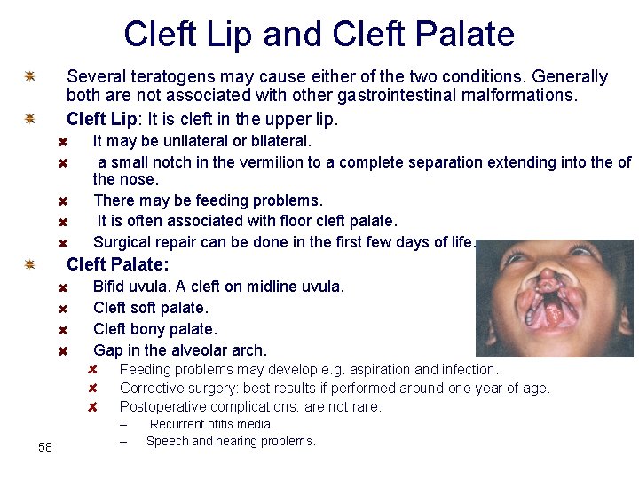 Cleft Lip and Cleft Palate Several teratogens may cause either of the two conditions.