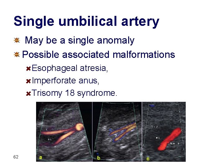 Single umbilical artery May be a single anomaly Possible associated malformations Esophageal atresia, Imperforate