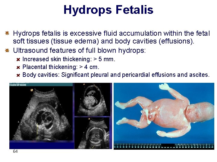 Hydrops Fetalis Hydrops fetalis is excessive fluid accumulation within the fetal soft tissues (tissue